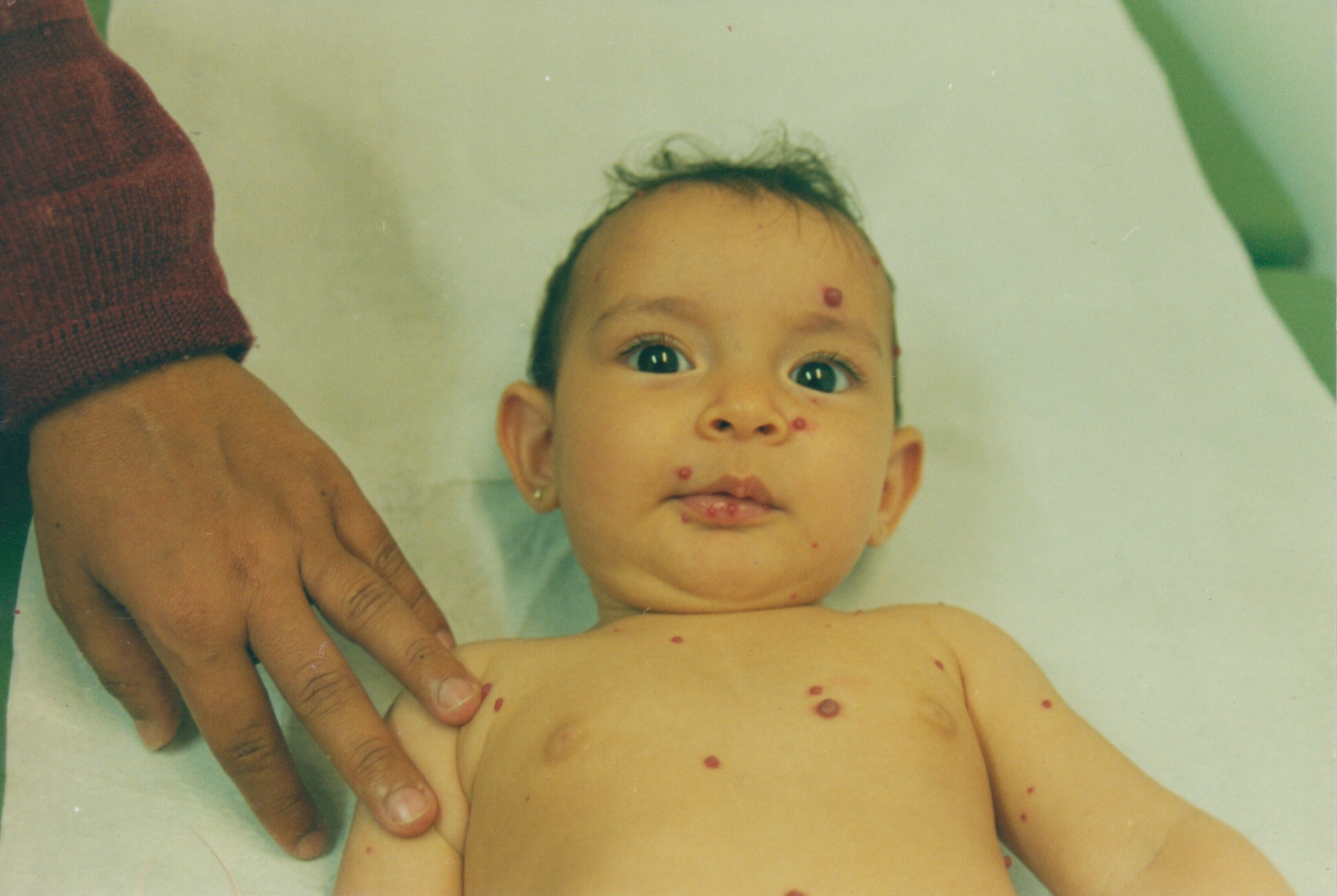 Uma fase bem difícil porque quando a Isabella nasceu, depois de alguns meses, começou a aparecer algumas bolinhas de sangue, chamadas hemangiomas. Depois de muitos médicos, um especialista sugeriu um medicamento que seria como um teste ainda. Nessa fase, a Allergan nos ajudou muito.